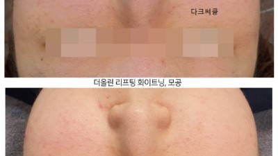 더올린 리프팅