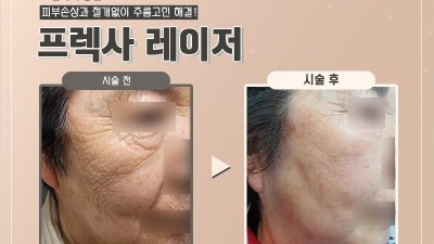 프렉사 리프팅